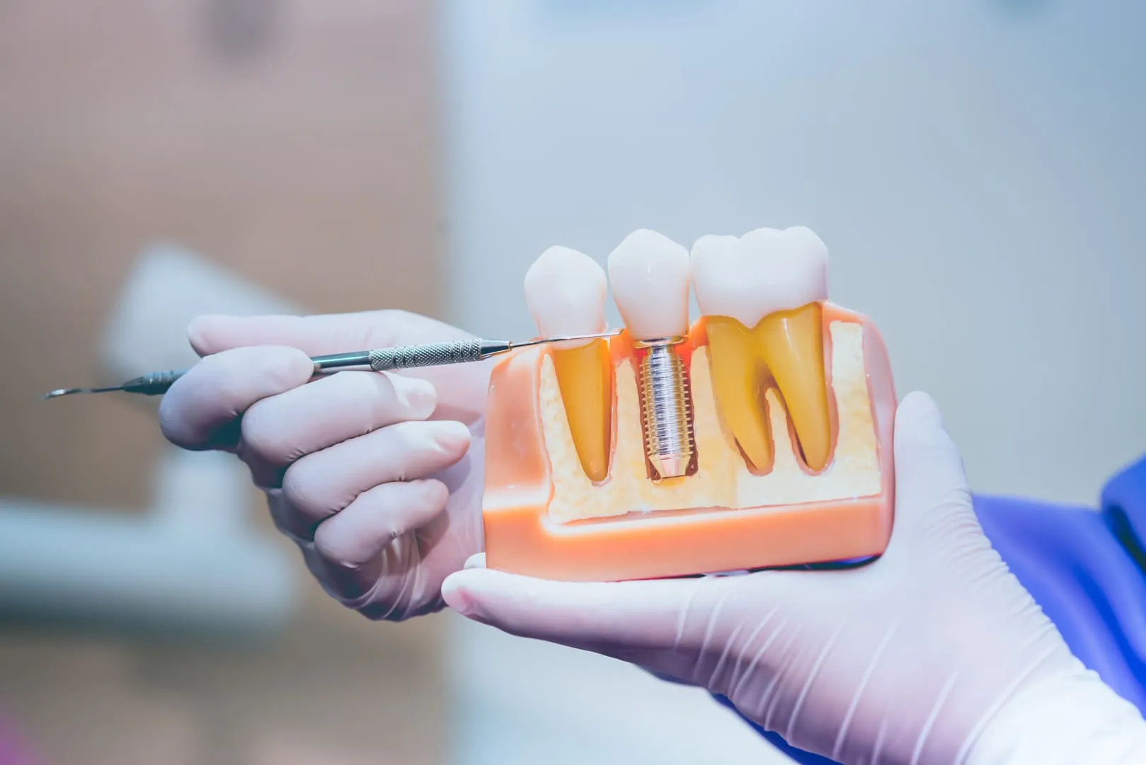 Dental Implants in Atlanta, GA